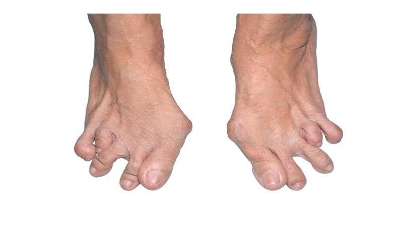 Как лечить полиартрит ног