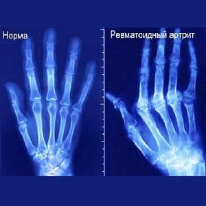 Что такое ревматоидный полиартрит и как его лечить