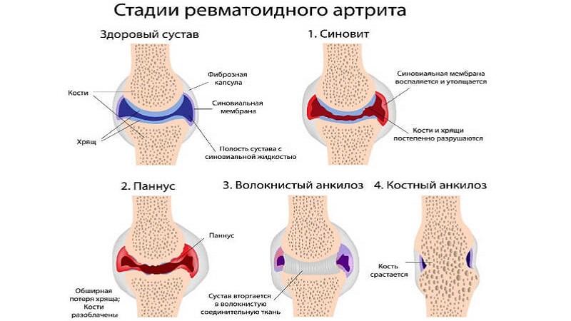 Что такое ревматоидный полиартрит и как его лечить
