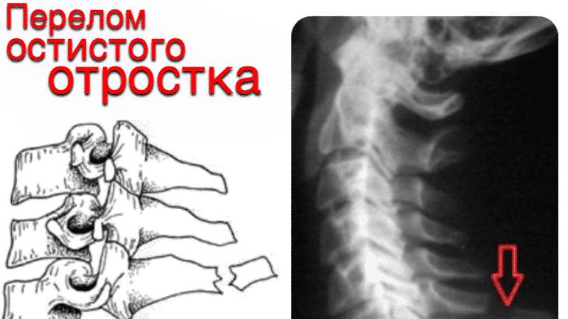 Как лечить перелом отростков позвоночника