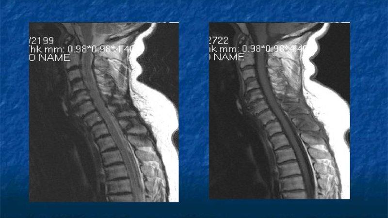 Как лечить перелом отростков позвоночника