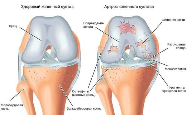 Как лечить посттравматический артроз