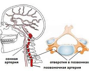 Что такое гипоплазия позвоночной артерии