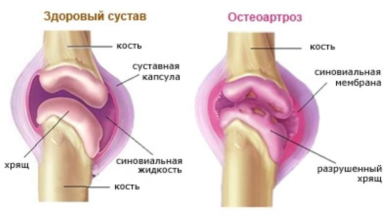 Остеоартроз