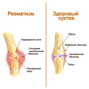 Какие препараты применяются для лечения ревматизма