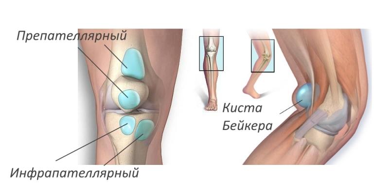 Как лечить препателлярный бурсит коленного сустава