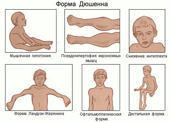 Как лечить синдром Дюшенна
