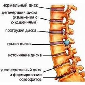 Стерся межпозвоночный диск - что делать