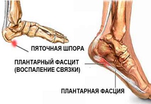 Как лечить пяточную шпору