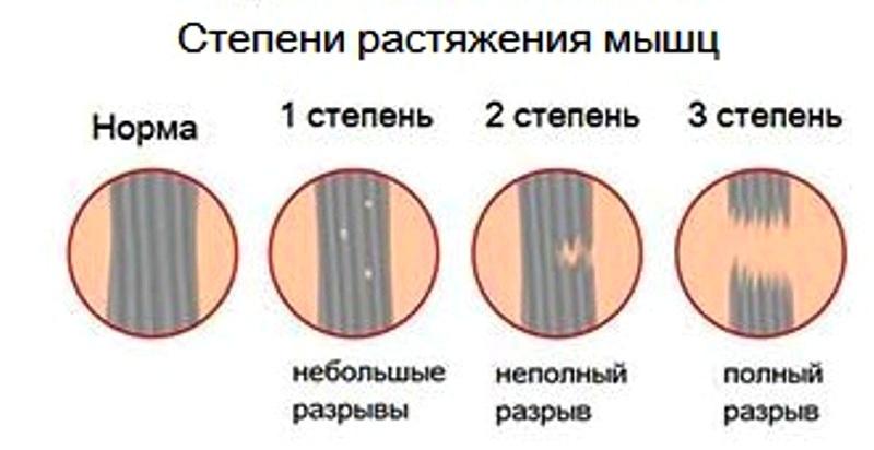 Степень растяжения мышцы