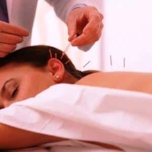 Иглоукалывание