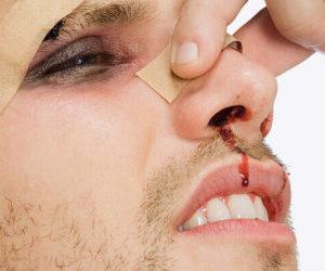 Как делают репозицию костей носа