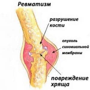 Как лечить ревматизм ног
