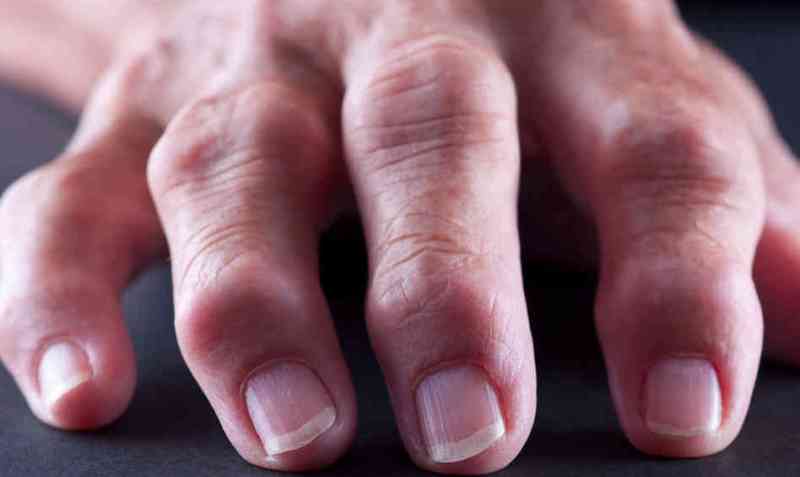 Как лечить ревматоидный артроз