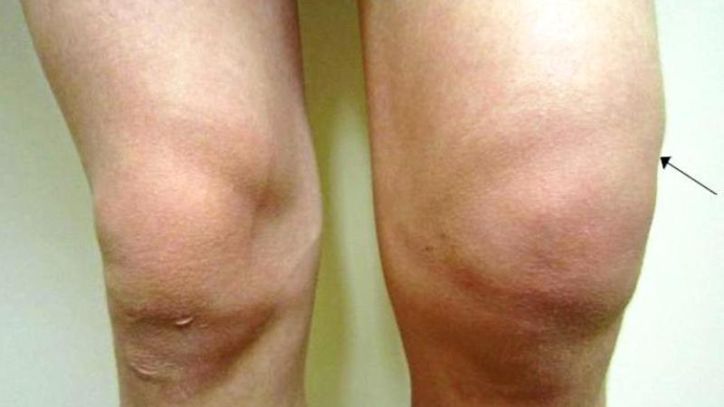 Как лечить ревматоидный артроз