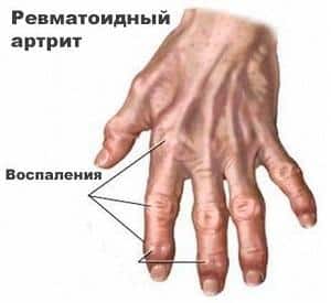 Как принимать Плаквенил при ревматоидном артрите
