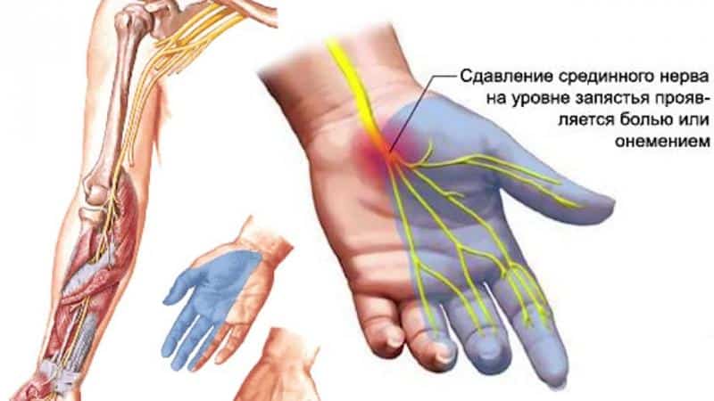 Что такое туннельный синдром