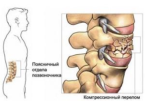Что такое компрессионный перелом позвоночника и как он лечится