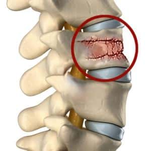 Насколько опасна трещина в позвоночнике