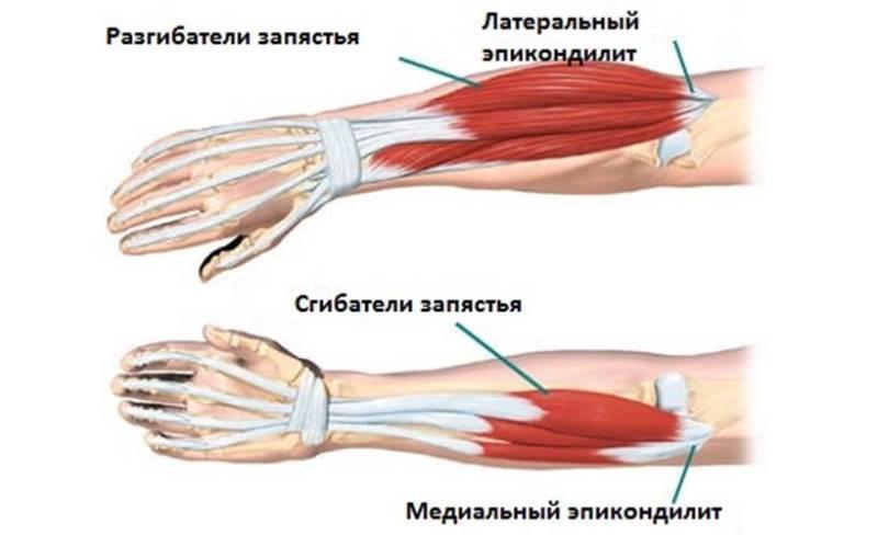 Что такое эпикондилит сустава и как его лечить