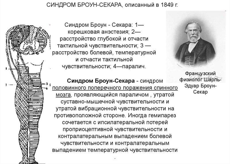 Синдром Броун-Секара