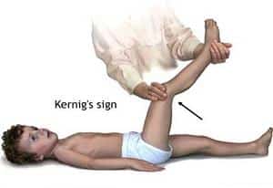 Что такое симптомы Кернига и Брудзинского