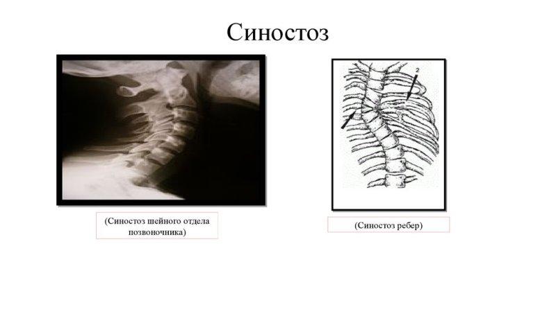 Что такое синостоз