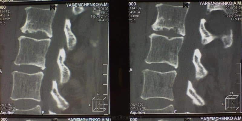 Что такое спондилодисцит позвоночника и как его лечат