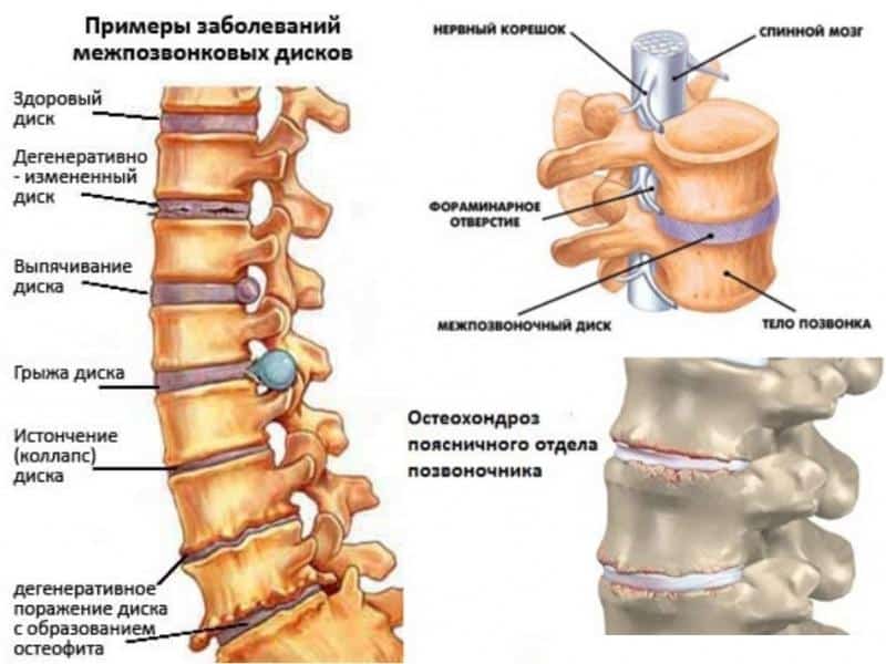Что такое спондилодисцит позвоночника и как его лечат