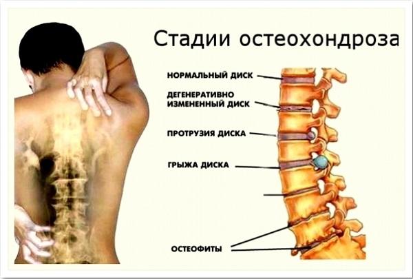 Что делать при обострении остеохондроза