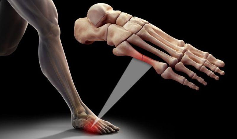 Плюсневые кости