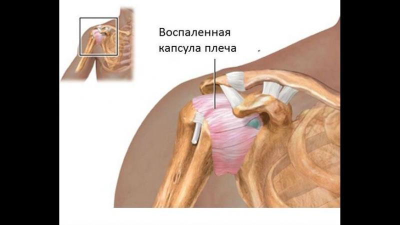 Как устроен плечевой сустав у человека