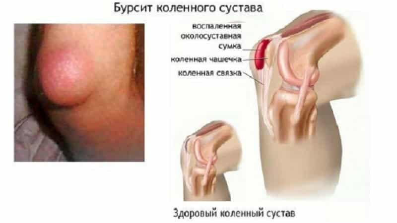 Что такое супрапателлярный бурсит коленного сустава и как его лечить
