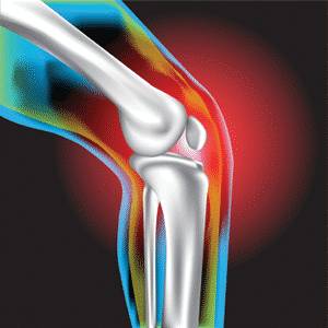 Что такое суставная мышь коленного сустава и как её лечить