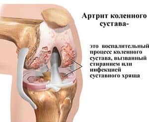 Как лечить артрит коленного сустава