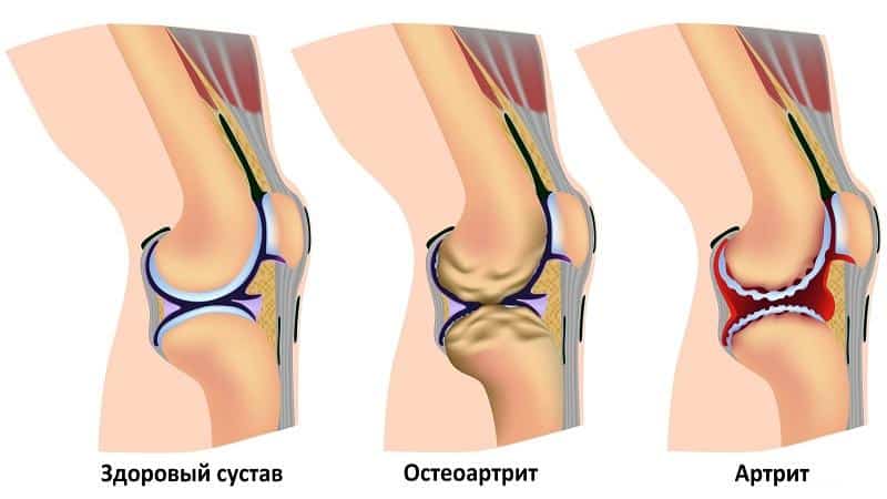 Какие уколы назначают при артрите
