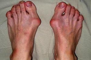 Чем отличается артрит от артроза