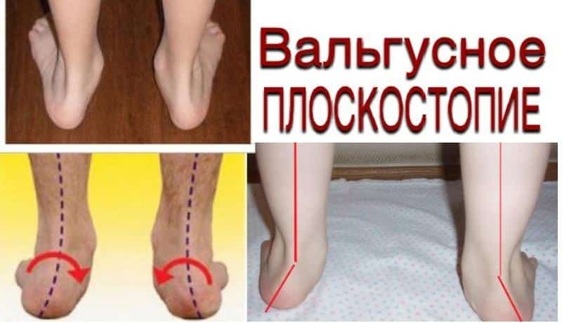 Как лечить вальгусное плоскостопие