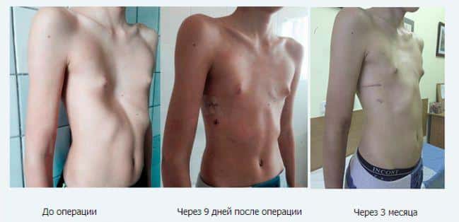 Как лечить вогнутую грудную клетку