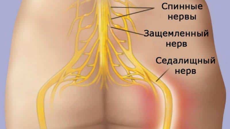 Как вылечить седалищный нерв народными средствами