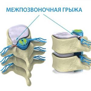 Как проходит операция по замене межпозвоночного диска